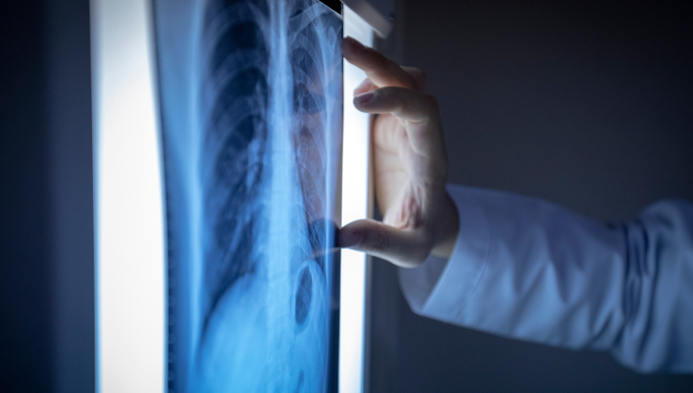 Lung Cancer Treatment