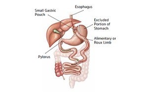 Gastric Bypass