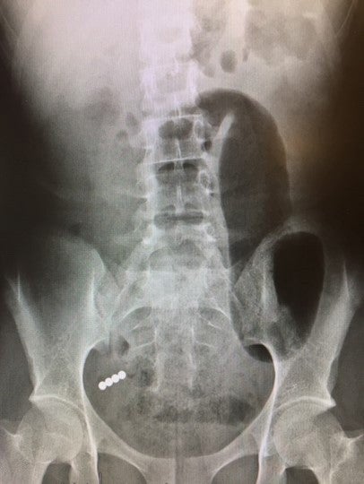 An X-ray of a child who swallowed rare earth magnets (circular objects on the left).