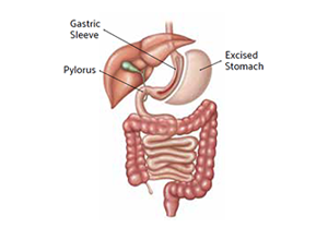 Gastric Sleeve