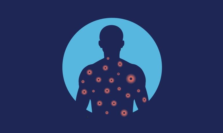 What you need to know about measles