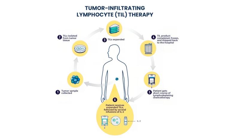 Discover how LVHN is preparing to offer tumor-infiltrating lymphocyte (TIL) therapy, a leading-edge cellular immunotherapy for melanoma and future clinical trials.