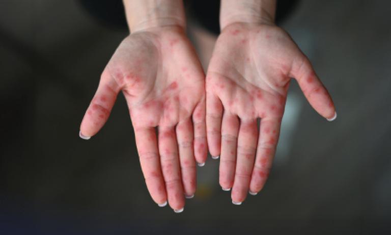 Hand, foot and mouth disease is common in children, but adults also get it. Learn what we can all do to prevent and treat HFMD.