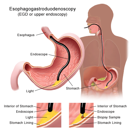 Gastroesophageal Reflux Disease (GERD), or Heartburn - Diagnosis 